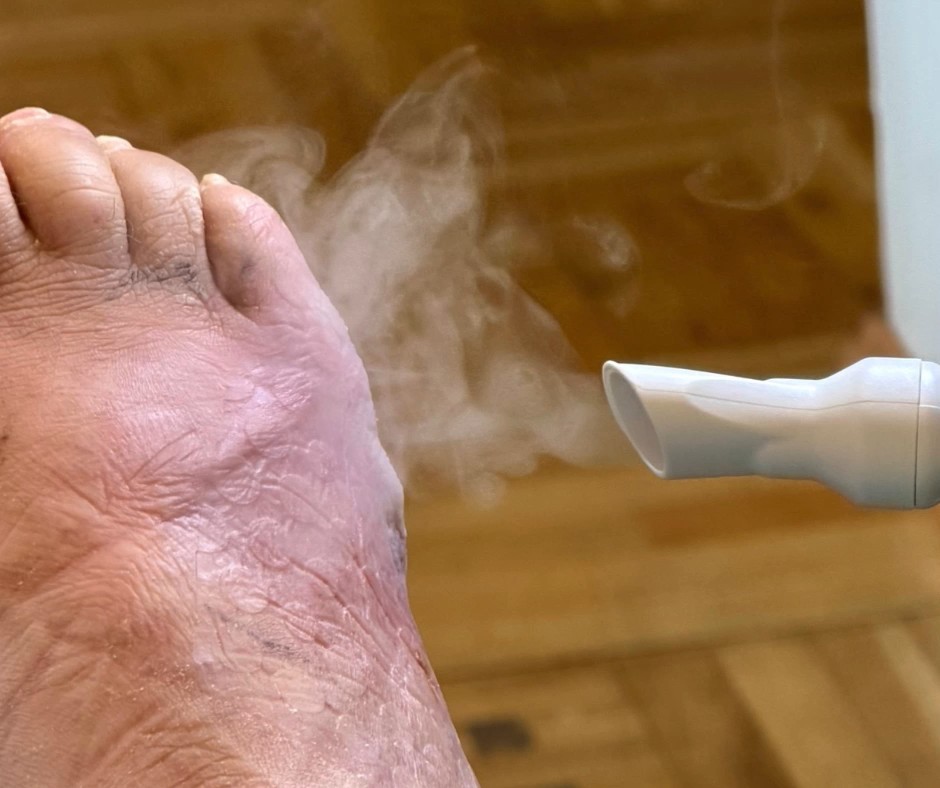 Plasmo Heal Kaltplasma-Aerosol im Einsatz bei der Fuß- und Wundbehandlung