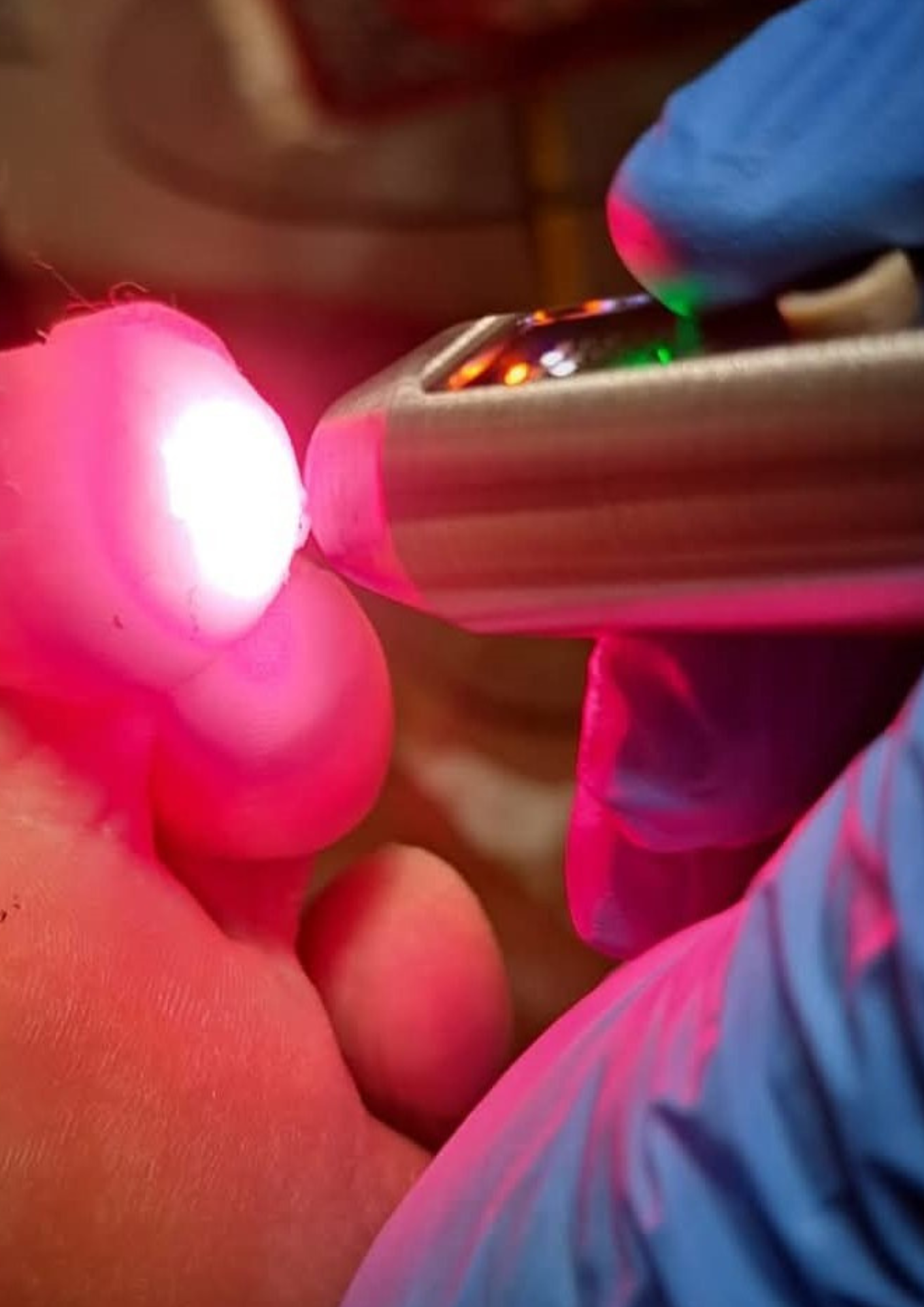 Laser Zehe